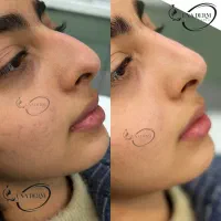 بوتاکس. فیلر. مزوتراپی و پی آر پی.فشیال