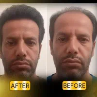 کاشت مو تضمینی  آقایان