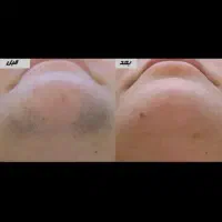 لیزر موهای زائد در منزل70٪ریزش مو تضمینی در ۱ جلسه