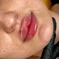 تزریق ژل و بوتاکس