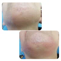 الکترولیز بانوان (رفع دائمی موهای زائد صورت و بدن)|خدمات آرایشگری و زیبایی|شیراز, گویم|دیوار