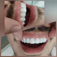 روکش لمینتی فقط با ۶ تومن اونم چک دو ماهه
