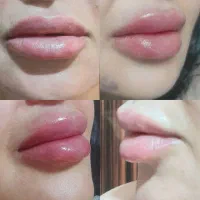 ژل  و بوتاکس  بانوان