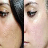 طرح عیدانه prp+مزو با پنجاه درصد تخفیف