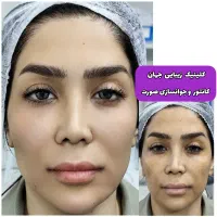 بوتاکس ژل/فیلرگونه زاویه/مزو/لیفت/عمل رفع غبغب پلک