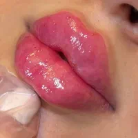 مدل ژل و بوتاکس رایگان