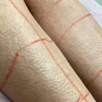 لیزرمو های زائدکندلا ۲۰۲۵ مکس آمریکا اصلی