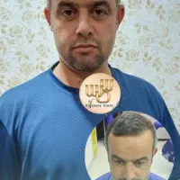 کاشت مو ابرو مزو و پی آر پی بوتاکس