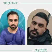 کاشت مو و ابرو با تراکم بالا