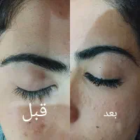 کاشت مژه واصلاح صورت