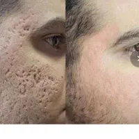 خداحافظی با کک و مک و لک و جوش ‌و جای جوش