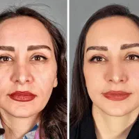 تزریق نخ مایع، لیفتینگ بدون جراحی، شرایط اقساطی