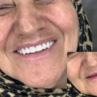 دندان مصنوعی فقط 7.800 به دلیل جشنوار عیدانه