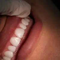 تخفیف ویژه کامپوزیت زیبایی دندان توسط دندانپزشک