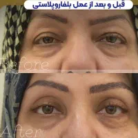 جشنواره جراحی پلک سانترال لب دایرکت ابرو