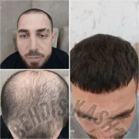 جشنواره تابستانه بهدیس کاشت فقط ۲۰ میلیون تومان