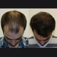 از جمع کچلا در بیا