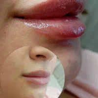 تزریق ژل لب و بوتاکس