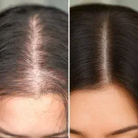 نجات موهای درحالِ ریزش