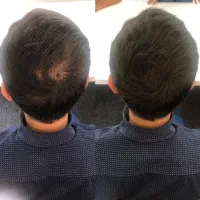 کاشت مو و ابرو با قیمت پایین و اقساطی