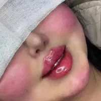 فقط 2روزمادلینگ خلیجی۱۴۰۰ بوتاکس و ژل240انزیم300
