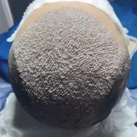 کاشت به قیمت سال قبل کاشت مو،ریش،ابرو،بلفاروپلاستی