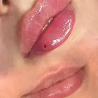 تخفیف ژل و بوتاکس و مزو