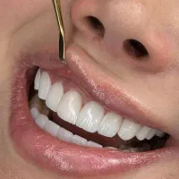 دندان پزشکی/دندانسازی/کامپوزیت/روکش/عصب کشی