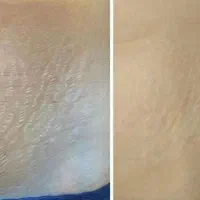 درمان ترک پوستی با جدیدترین متد روز دنیا