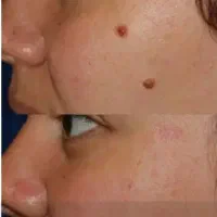 برداشت خال و زیگیل ،ارزان تر و با دقت