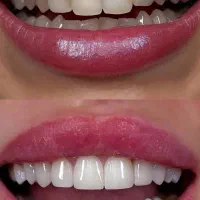 یک فک کامپوزیت سارمکو یک فک رایگان