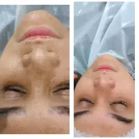 پاکسازی و فشیال پوست تخفیف ویژه