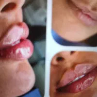 فیلر،بوتاکس،مزو،پی آرپی،فشیال