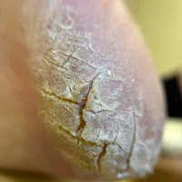 تخفیف ۵۰٪ خدمات پدیکور و ژلیش پا