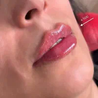 مدل جهت تزریق فیلر لب روسی و نچرال