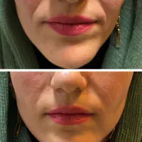 فیلر، بوتاکس، مزوتراپی و خدمات پوست و مو توسط پزشک