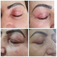 لیفت پلک خالبرداری لیزر تضمینی