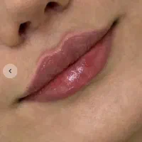 تزریق ژل و بوتاکس