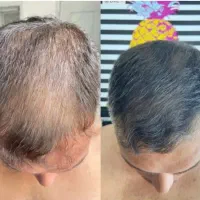 احیای نوین مو