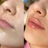آفر ویژه خدمات زیبایی بوتاکس فیلرو.. کلینیک پزشکی|خدمات آرایشگری و زیبایی|کرج, جهانشهر|دیوار