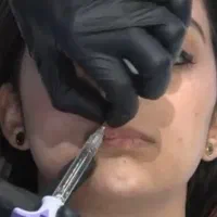 تزریق لب روسی و کانتورینگ تخفیف ویژه