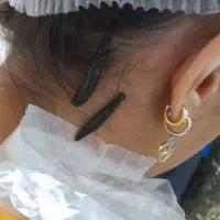 حجامت زالو درمانی بادکش