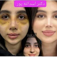 جراحی بینی قیمت عالی دکتراسدالله پور۳۱میلیون