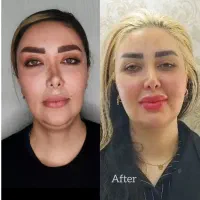 مرکز تزریق چربی در تهرانسر