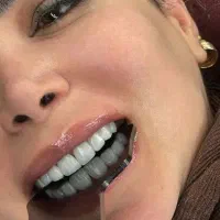 تخفیف ویژه کامپوزیت، روکش ...