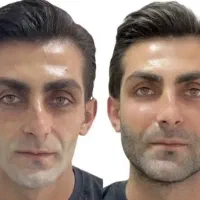 خدمات ژل،بوتاکس،مزو وپی ارپی،کاشت مووابرو،ساکشن