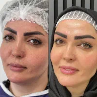 کاشت ابروی طبیعی