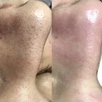 تخفقف ویژه پاکسازی صورت فیشال