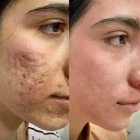 جوش و جای جوش فقط در ۲ماه ونیم