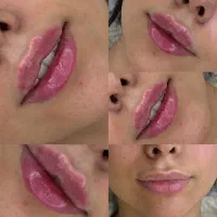 فیلر،بوتاکس،نخ